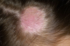 Профилактика дерматомикозов