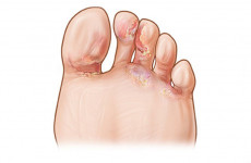 Профилактика дерматомикозов