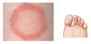 Профилактика дерматофитии