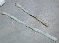 Дифиллоботриоз