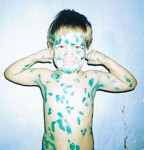 Профилактика ветряной оспы у детей