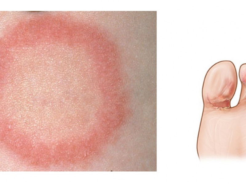 Профилактика дерматофитии