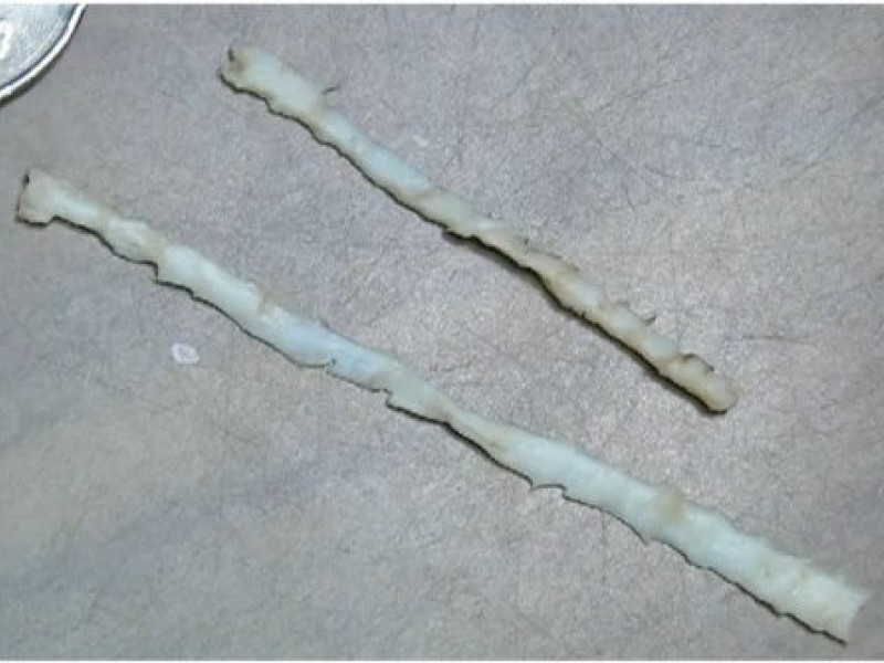 Дифиллоботриоз