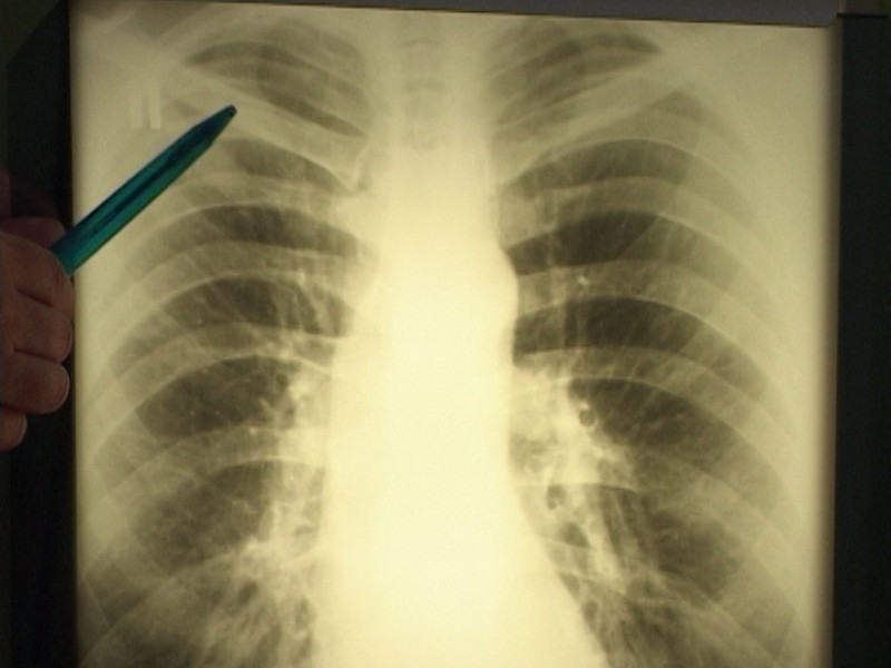 Процент заболевания высок