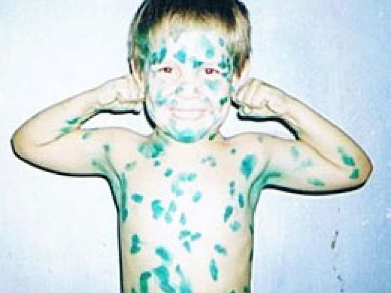 Профилактика ветряной оспы у детей