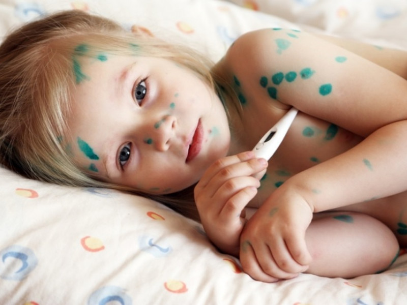 Профилактика ветряной оспы